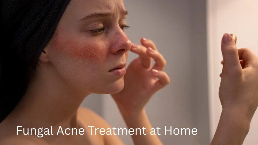 Fungal Acne Treatment at Home