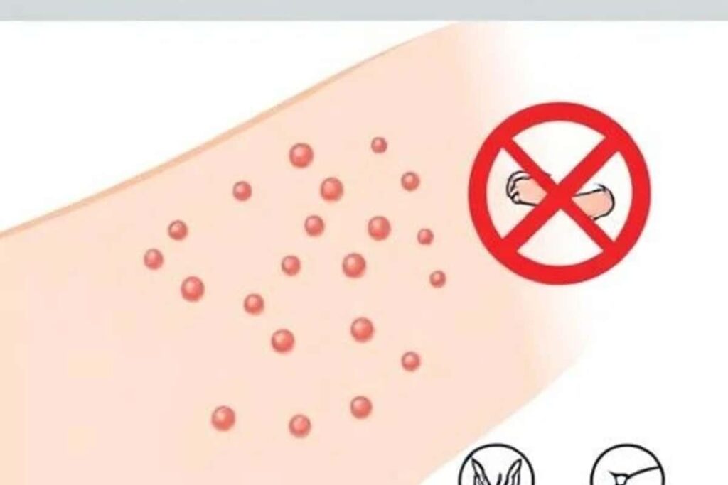 Fungal acne on skin, showing non-contagious yeast-related breakouts