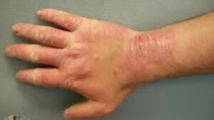 Skin Cancer Symptoms Itchy