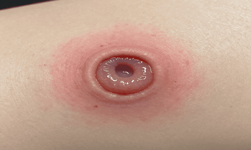 skin abscess symptoms redness, swelling, pus