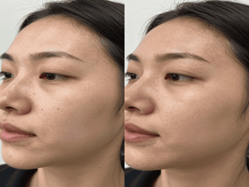 Before and after results of laser treatment on dark spots