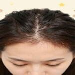 Female Pattern Hair Loss in women showing gradual thinning on the crown and widening part line
