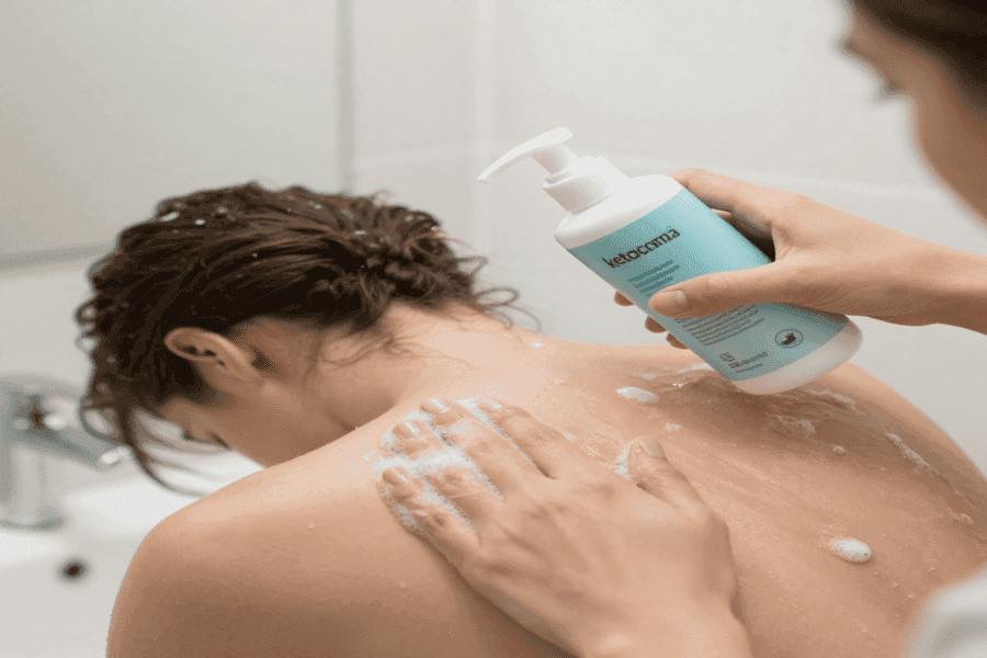 fungal acne treatment at home using antifungal body wash ketoconazole shampoo