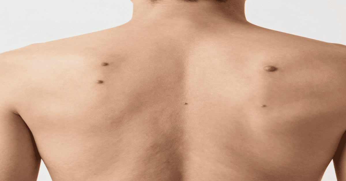 fungal acne treatment at home showing malassezia folliculitis with small uniform itchy bumps