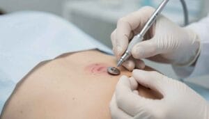 Punch biopsy with circular tool on patient’s skin.