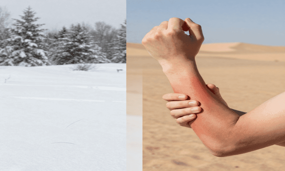 Winter cold and dry desert climate causing dry skin in USA